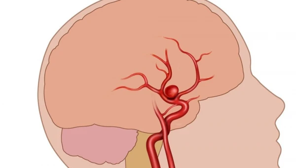 Неврологи из США назвали способы защититься от аневризмы головного мозга