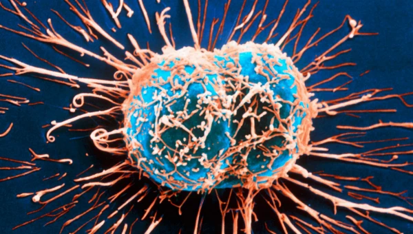 NEJM: Комбинация лекарств знаменует успех в борьбе с раком мочевого пузыря