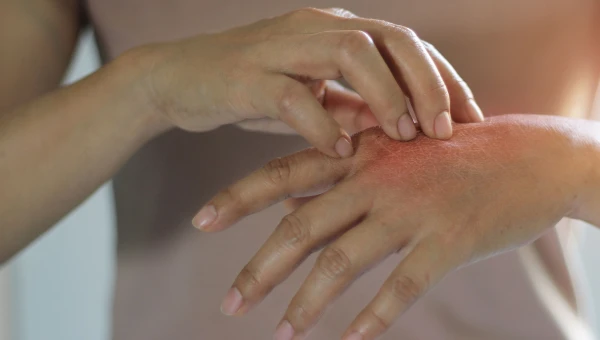Эпигенетика имеет решающее значение при аутоиммунных кожных заболеваниях
