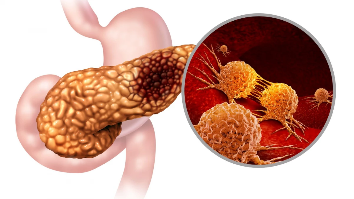 Вылечил рак поджелудочной железы. Злокачественное новообразование поджелудочной железы. Раковые клетки в организме человека. Панкреатит фон. Випома поджелудочной железы.