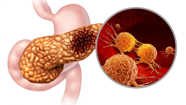 Gut: Бактерии полости рта ускоряют развитие рака поджелудочной железы