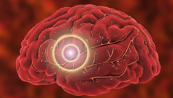 Neurology: У людей с ССЗ распространены скрытие изменения мозга