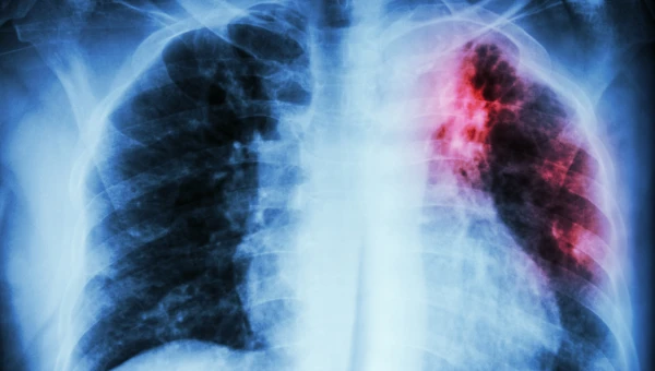 Nature Communications: В фиброзе лёгких играет роль белковый сенсор