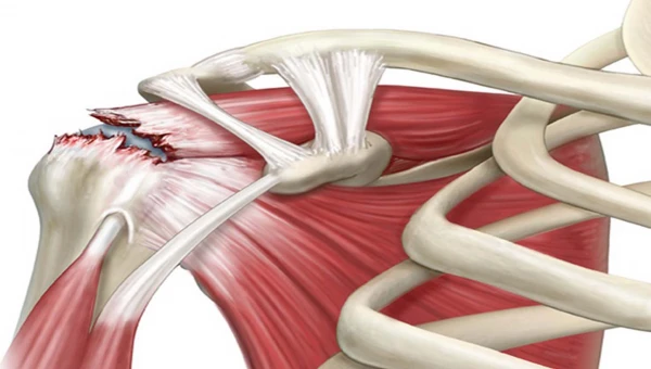 Двустороннее клеточное лечение помогает восстановить мышцы после травмы плеча