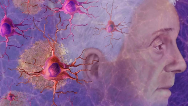 Cell Press: Болезнь Альцгеймера передаётся при трансплантации костного мозга