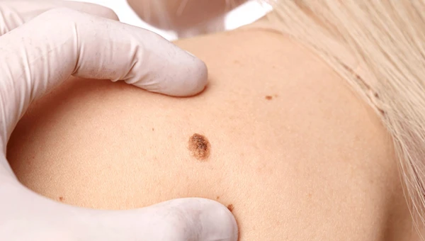 Врач Исакова заявила, что бляшки на коже могут быть симптомом рака желудка
