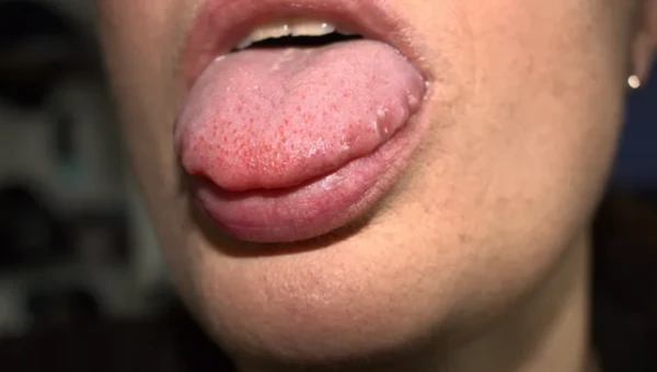 HuffPost: «Зубчатый язык» может быть признаком дефицита витаминов