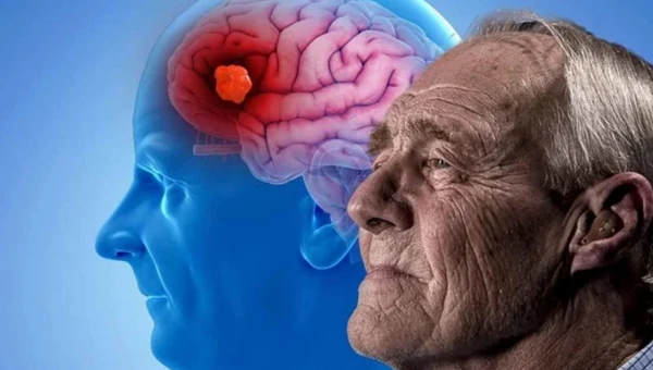 NM: Копии гена APOE4 могут способствовать развитию болезни Альцгеймера