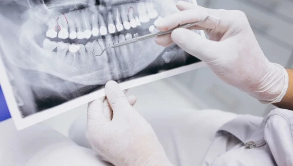 Липкие фруктовые полоски улучшают качество рентгеновских снимков зубов