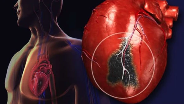 Терапевт Баркулова: Отказ от приема лекарств при гипертонии ведет к инфаркту