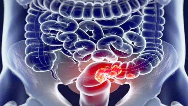 Онколог Мадан: Колоректальный рак вызывает употребление фаст-фуда и сладостей