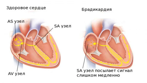 Брадикардия: Когда медленный пульс становится проблемой