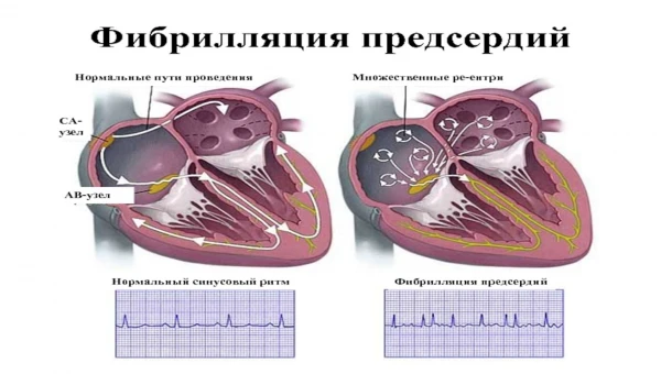 Фибрилляция предсердий: Опасное заблуждение и повышение риска инсульта