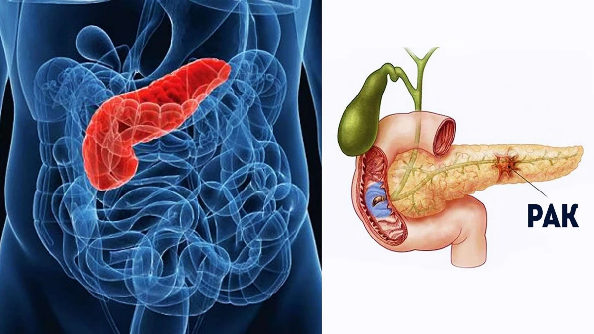 Карцинома поджелудочной железы симптомы. Инфильтрат поджелудочной железы кт. Опухоль поджелудочной железы мрт. Доброкачественные эпителиальные опухоли поджелудочной железы. Метастазы в поджелудочной железе.